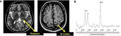 Preservation of thalamic neuronal function may be a prerequisite for pain perception in diabetic neuropathy: A magnetic resonance spectroscopy study